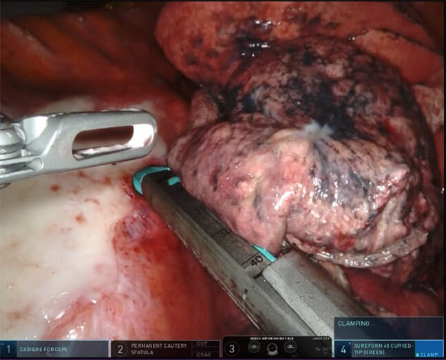 手術支援ロボット下右S6区域切除術